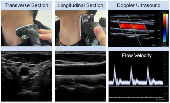 Karotid ve Vertebral Arter Renkli Doppler Ultrason