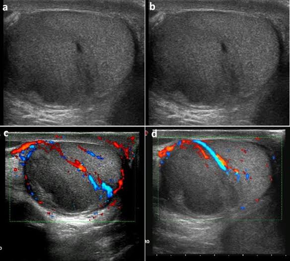 Skrotal Ultrason ve Skrotal Renkli Doppler Ultrason
